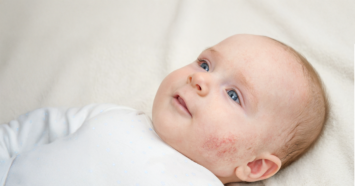 Types Of Skin Allergies in Babies: Eczema: